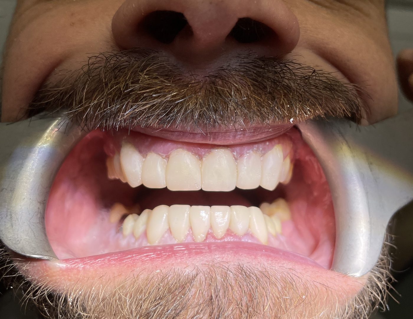 Retracted close-up view of the finished result, showing even, healthy-looking teeth