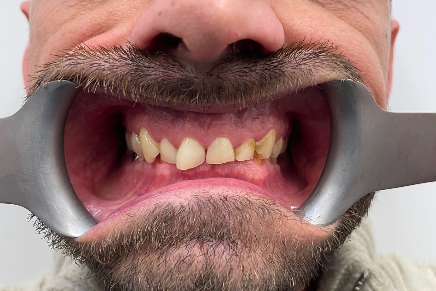 Retracted close-up view of worn, damaged front teeth before treatment