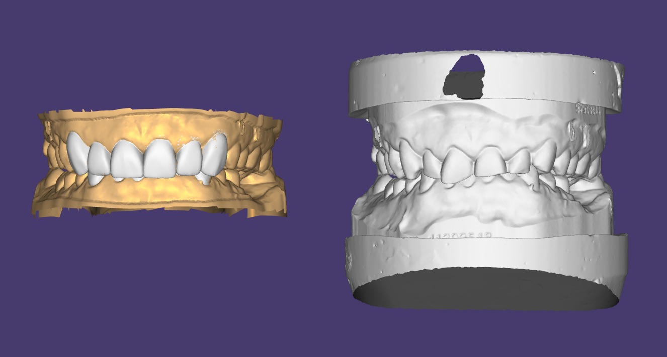 Digital treatment planning software showing the proposed tooth shapes overlaid on a scan of the patient's teeth