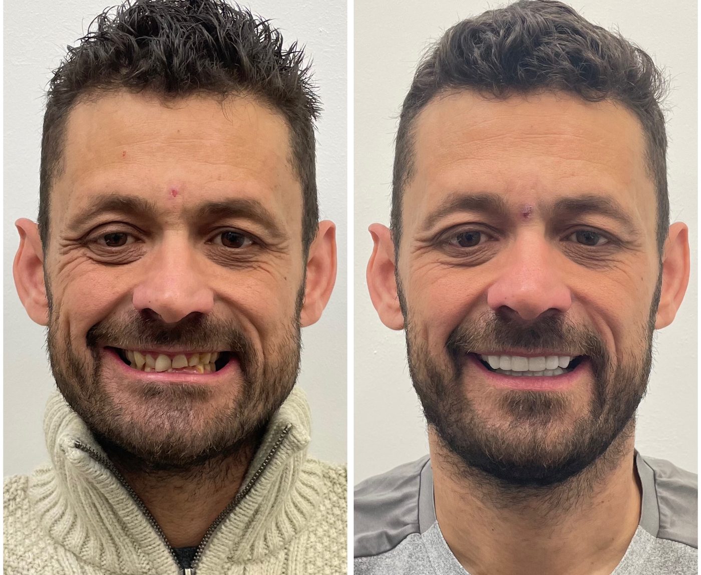 Before and after full mouth rehabilitation, DRJB Smile Clinic