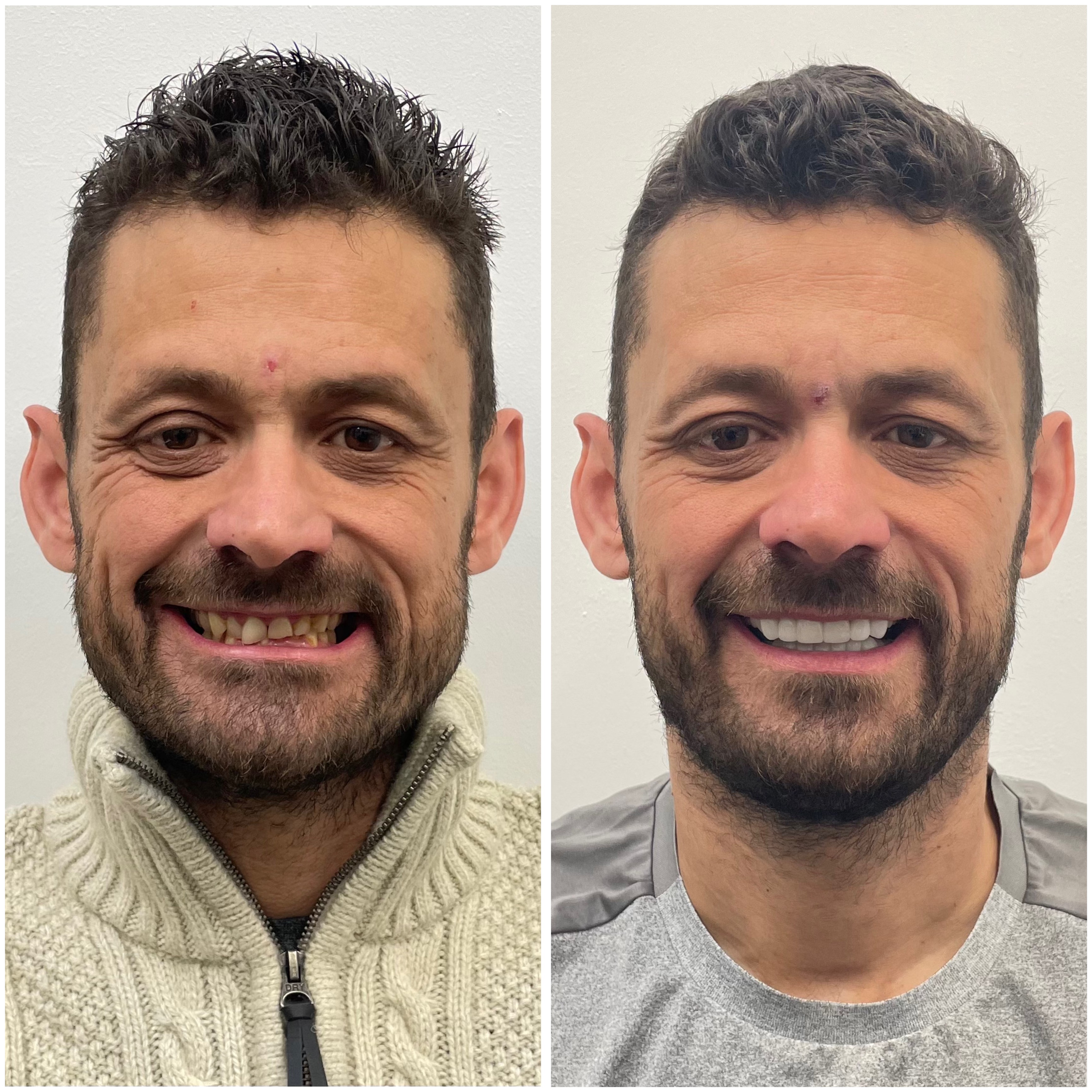 Before and after full mouth rehabilitation, DRJB Smile Clinic