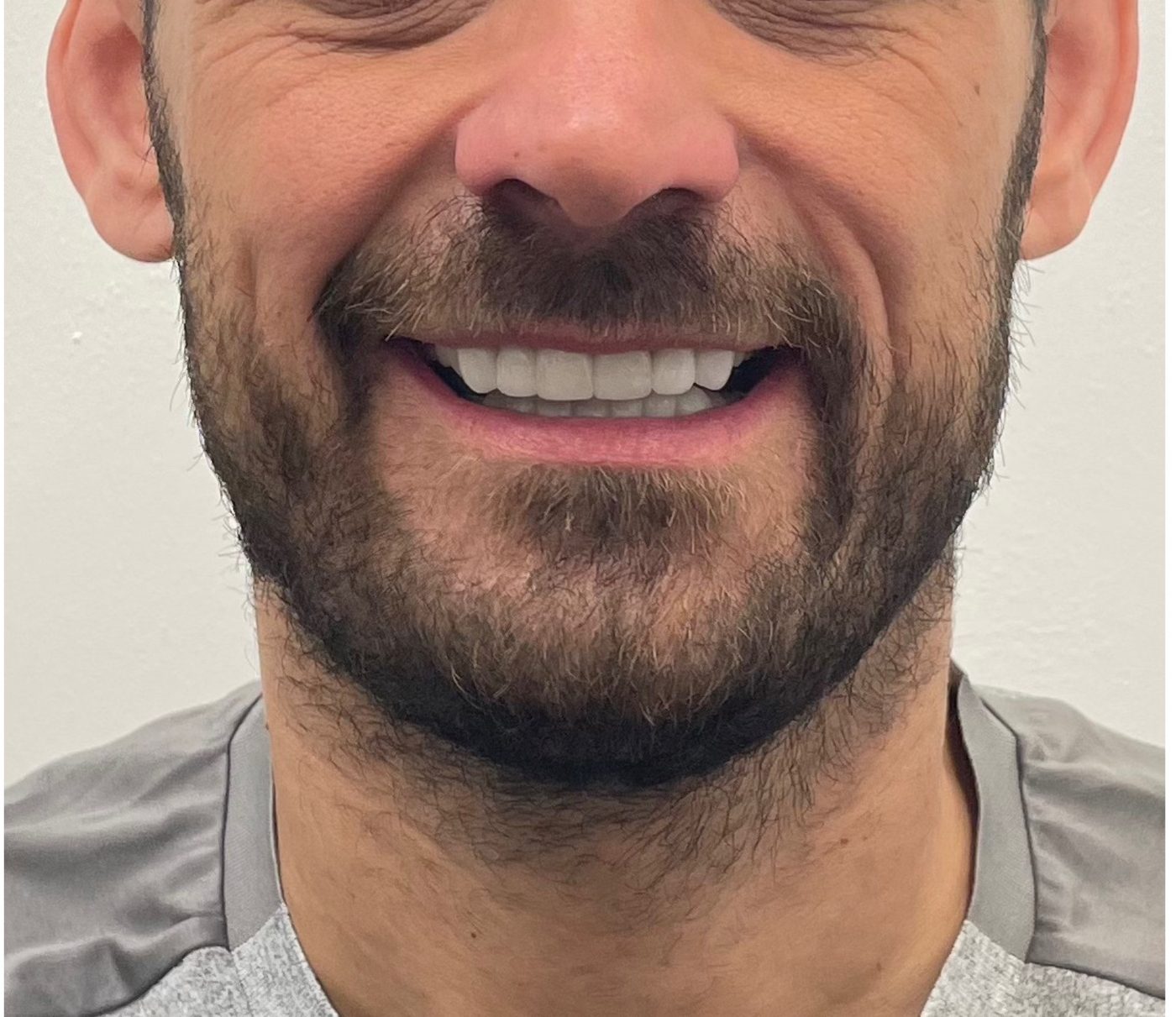 Natural smiling photo of the finished full mouth rehabilitation result