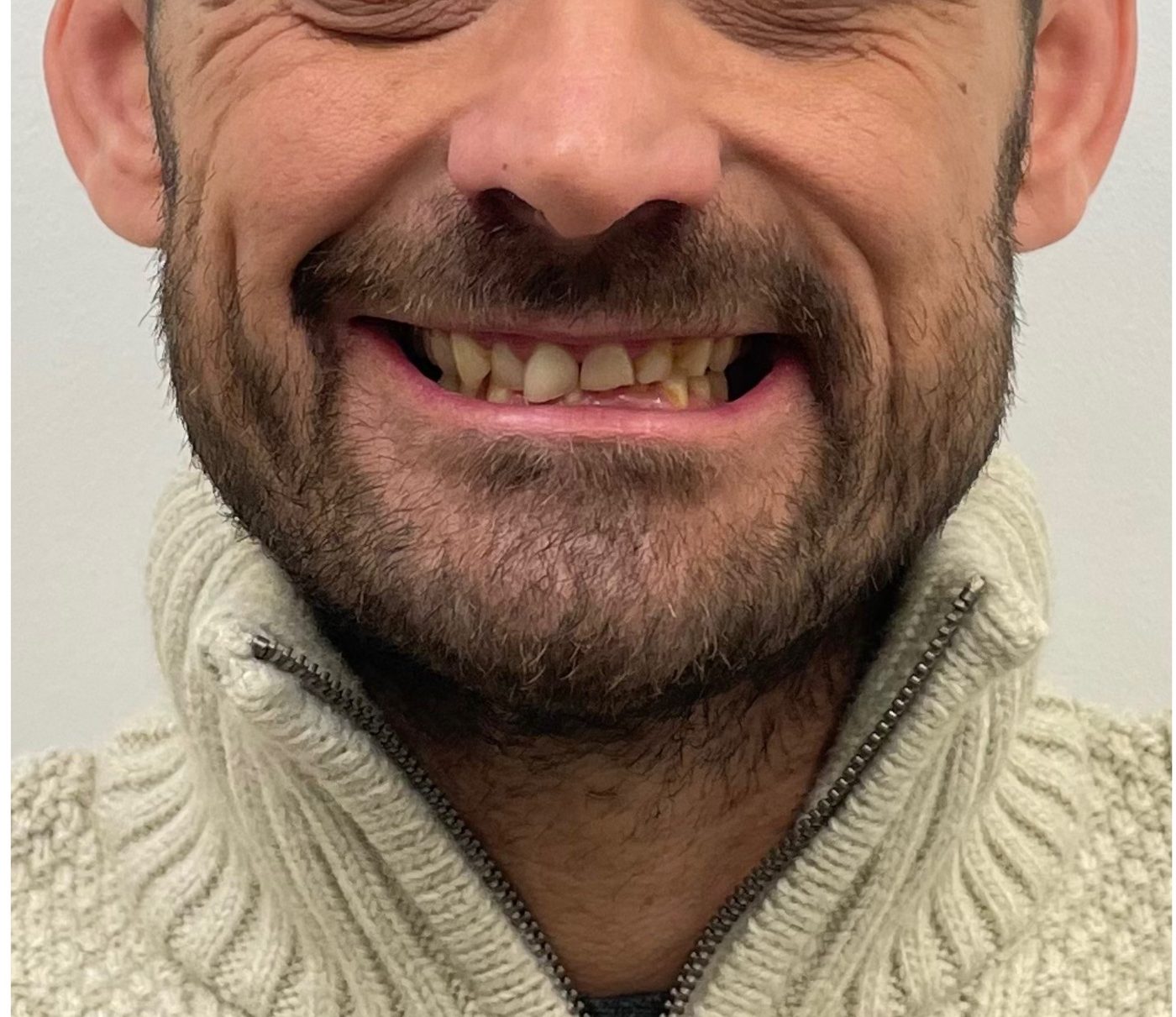Natural smiling photo of worn, damaged front teeth before treatment