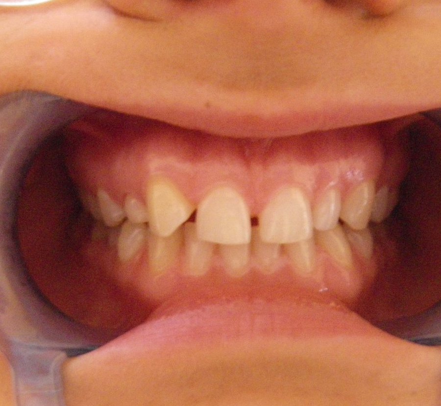 Retracted view of teeth before initial composite bonding treatment