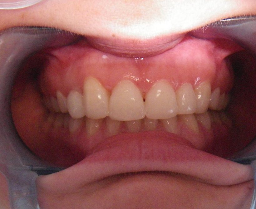 Retracted view of the result after initial composite bonding treatment