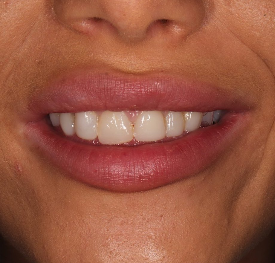 Close-up smile showing a shade mismatch and open contact where composite bonding had broken down years later