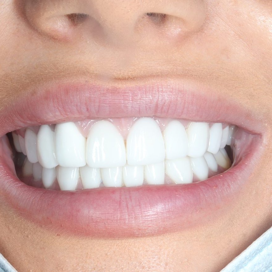Close-up smile showing the finished porcelain veneers and crowns result