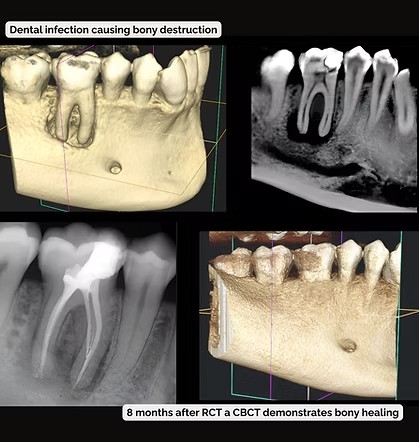 CBCT imaging showing bone destruction from dental infection, then bony healing eight months after root canal treatment