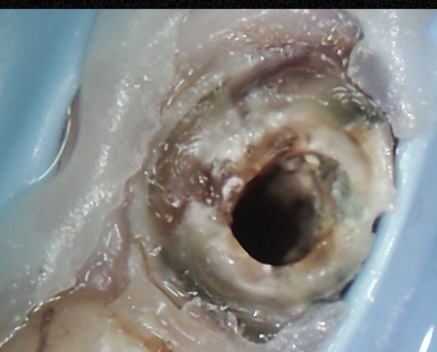 Clinical photograph of the canal space after successful post removal