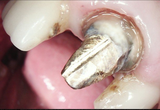 Clinical photograph of a crown sectioned to expose a cast post before endodontic retreatment