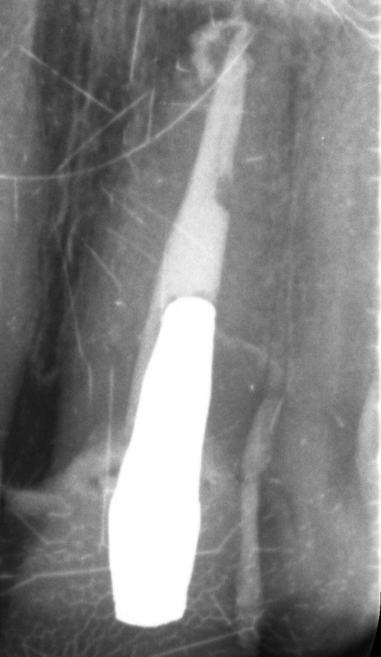 Post-operative periapical radiograph showing the completed root canal retreatment with bioceramic sealer
