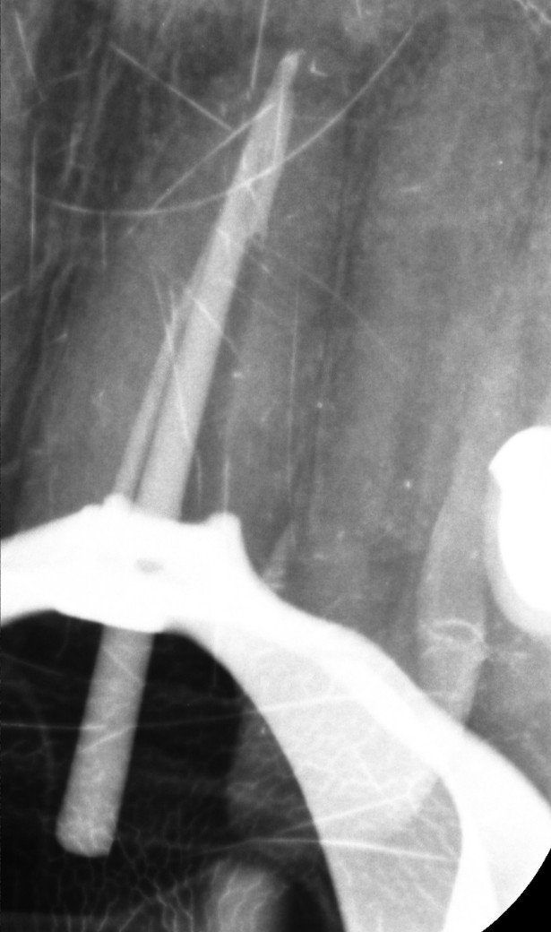 Periapical radiograph showing GP removal and a master cone seated at the apex during retreatment