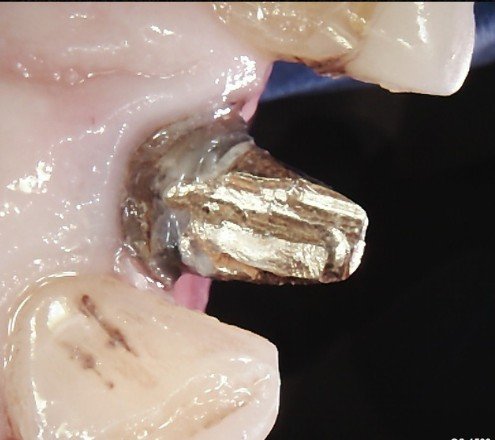 Clinical photograph of an exposed cast post prepared for removal under isolation