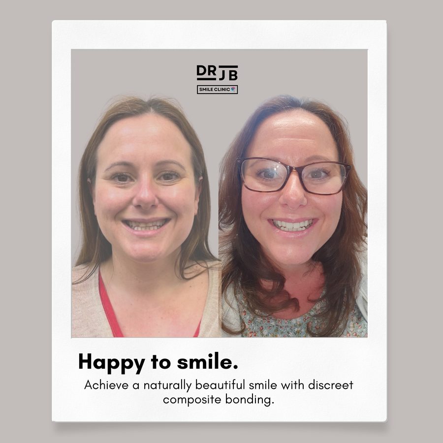 Before and after discreet composite bonding for a natural-looking smile, DRJB Smile Clinic