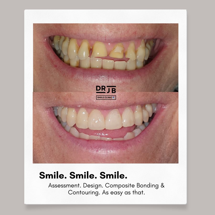 Before and after composite bonding and contouring on worn, discoloured front teeth, DRJB Smile Clinic