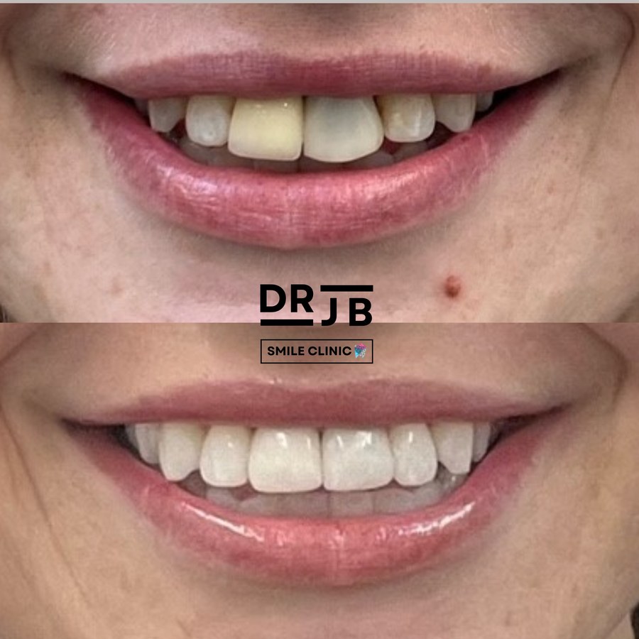 Before and after treatment transforming tooth shade and shape, DRJB Smile Clinic