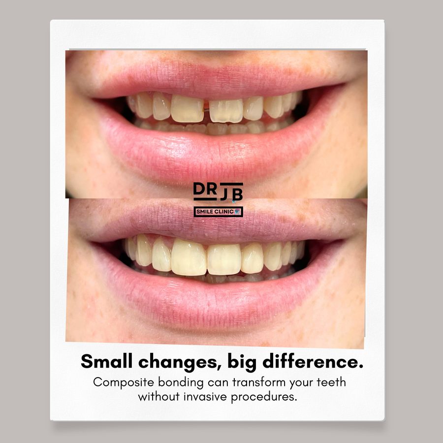 Before and after composite bonding closing a gap between front teeth, DRJB Smile Clinic