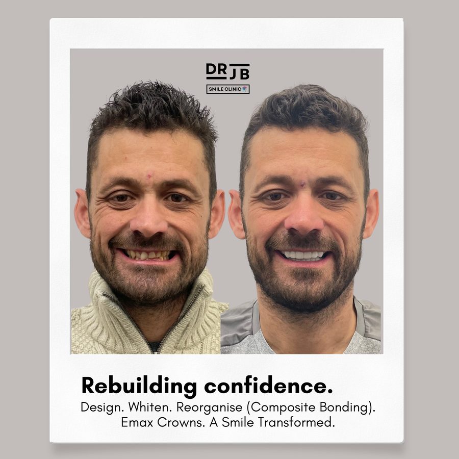 Before and after composite bonding, whitening and Emax crowns rebuilding a smile, DRJB Smile Clinic