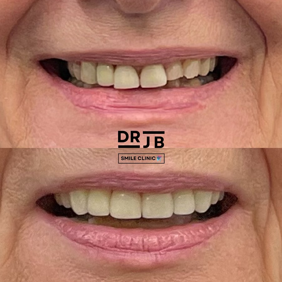 Before and after composite bonding closing a gap and evening tooth shade, DRJB Smile Clinic