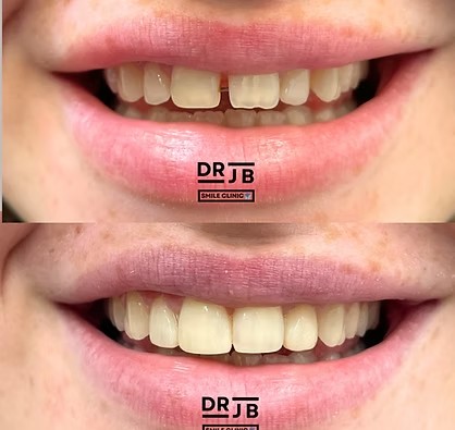 Before and after composite bonding closing a gap between the front teeth, DRJB Smile Clinic