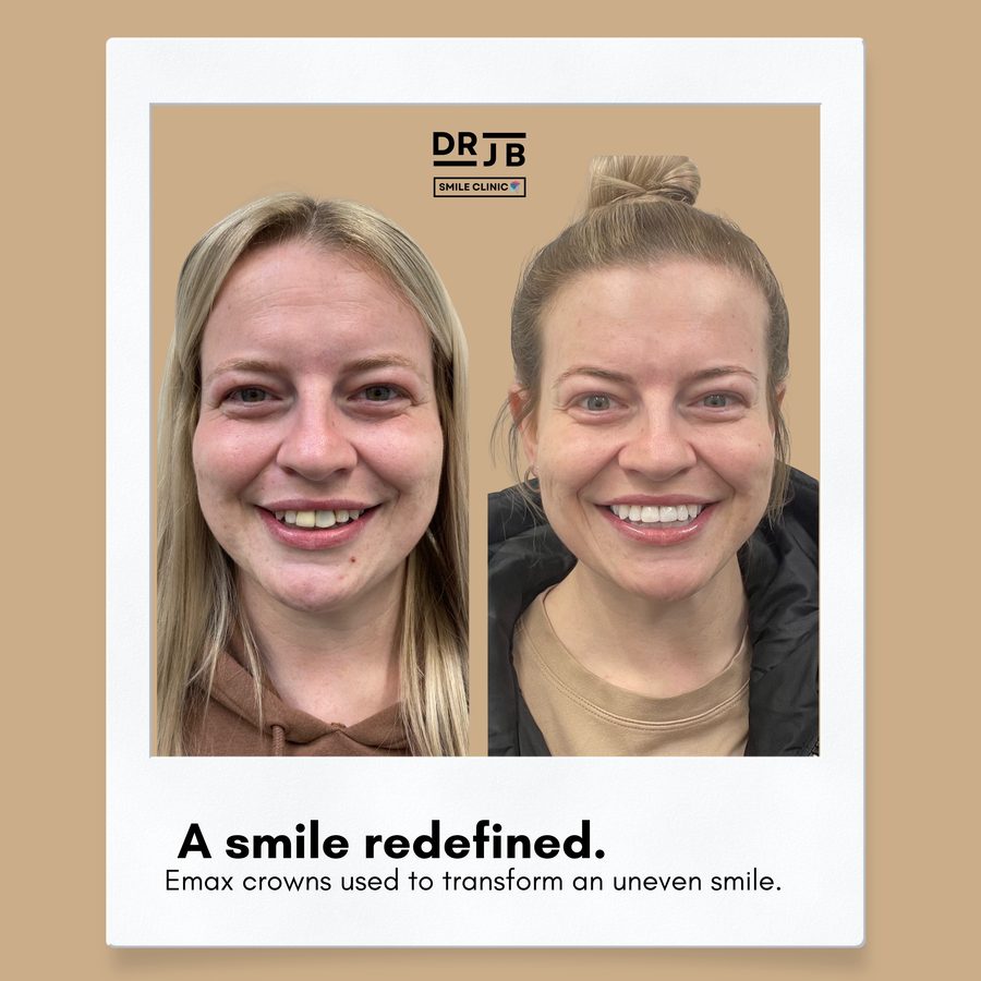 Before and after Emax crowns used to transform an uneven smile, DRJB Smile Clinic