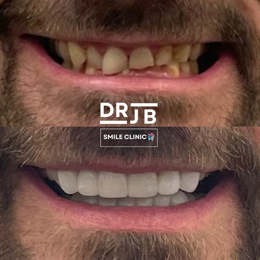 Before and after crowns rebuilding a discoloured, worn smile, DRJB Smile Clinic