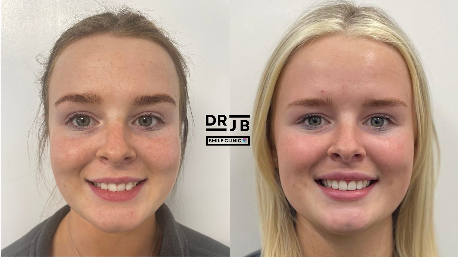 Before and after Quick Straight Teeth orthodontic alignment and composite bonding to refine tooth edges, DRJB Smile Clinic