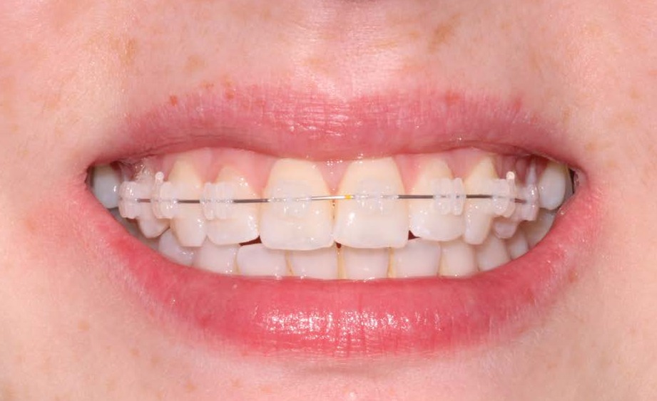 Mid-treatment, Quick Straight Teeth clear fixed appliance in place
