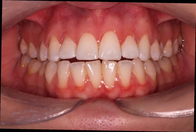 After Quick Straight Teeth treatment, upper front teeth aligned