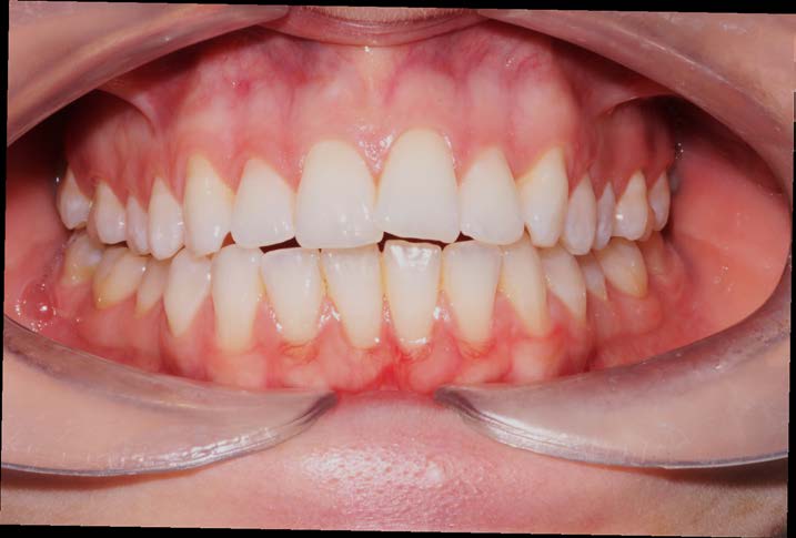 Before Quick Straight Teeth treatment, crossed-over upper front teeth