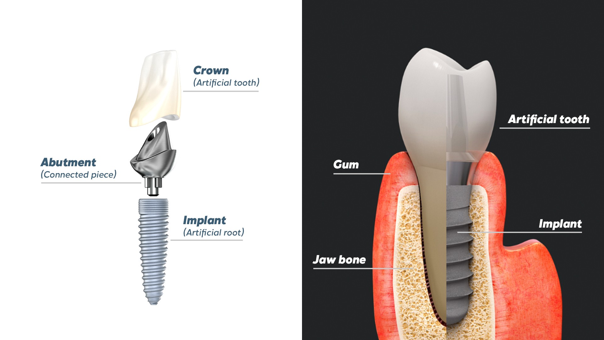Diagram showing the crown, abutment and implant components making up a dental implant