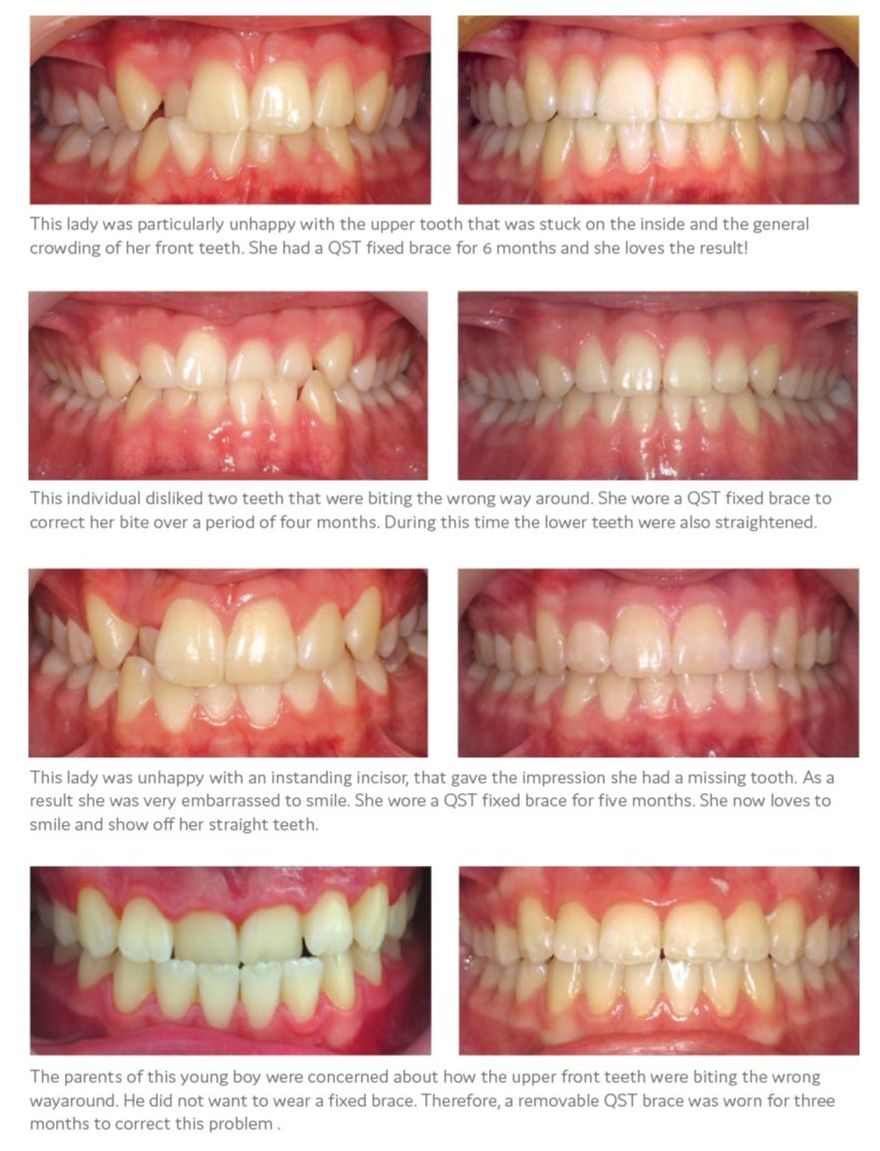 Quick Straight Teeth licensed example before and after cases, treated by other UK dentists
