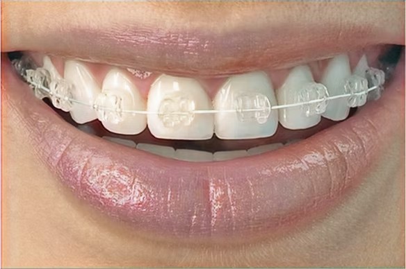 Natural smile showing Quick Straight Teeth clear brackets on the front teeth