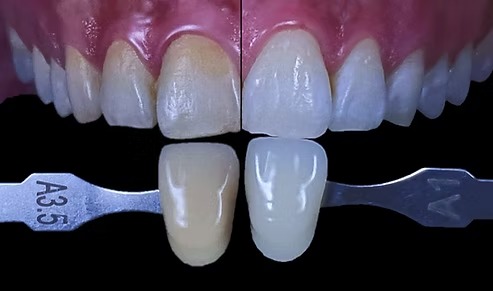 Side by side comparison of A3.5 average shade versus A1 brighter shade against real teeth