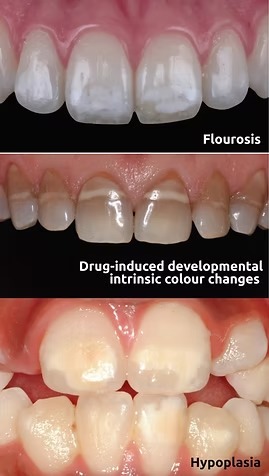 Three real clinical examples of tooth discolouration: fluorosis, drug-induced developmental colour changes, and hypoplasia