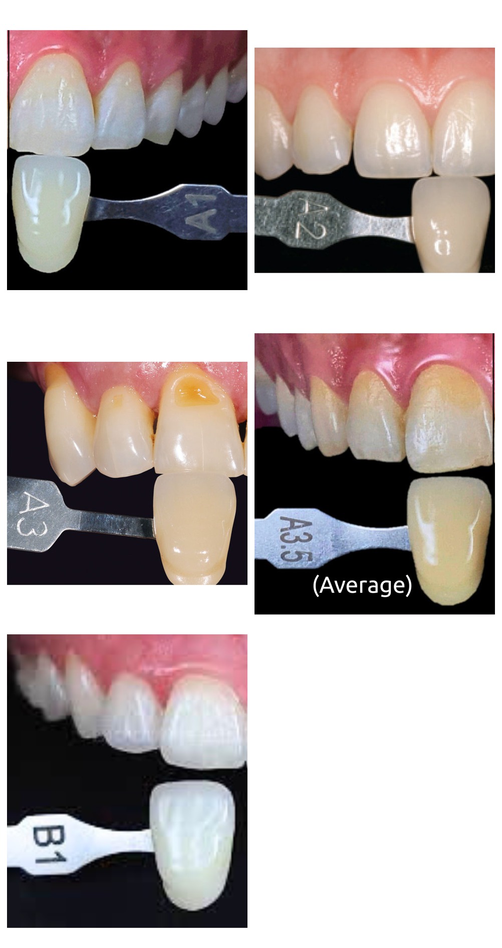 Five real examples comparing natural tooth shades against VITA shade tabs, ranging from A2 to B1