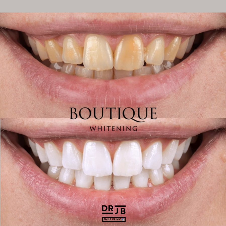 Example before and after result from Boutique Whitening, used with permission