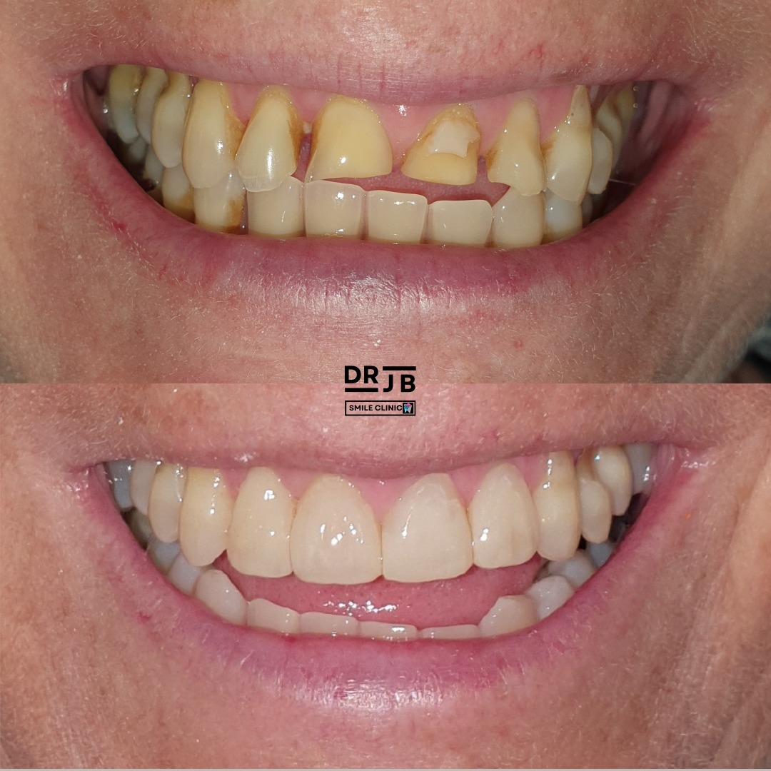 Before and after composite bonding and contouring, DRJB Smile Clinic
